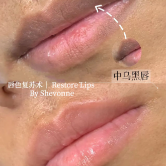 Lips Restoration (1)