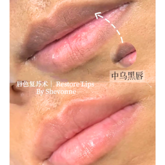 Lips Restoration 2