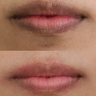 Lips Restoration