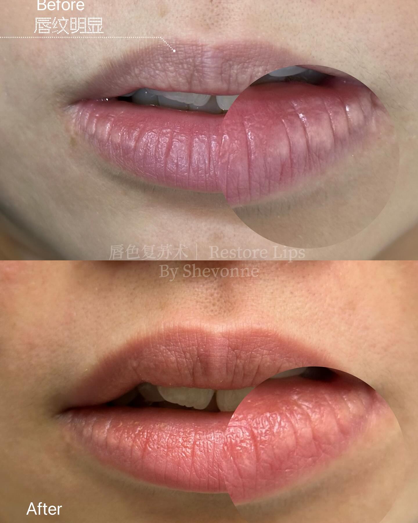 Dark Lips Treatment 1