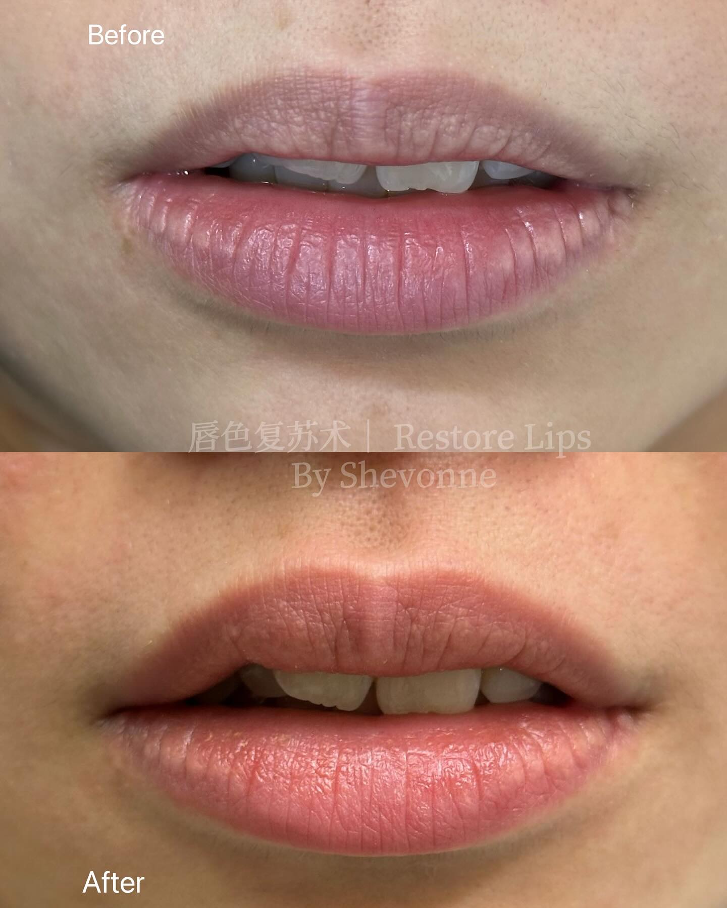 Dark Lips Treatment 2